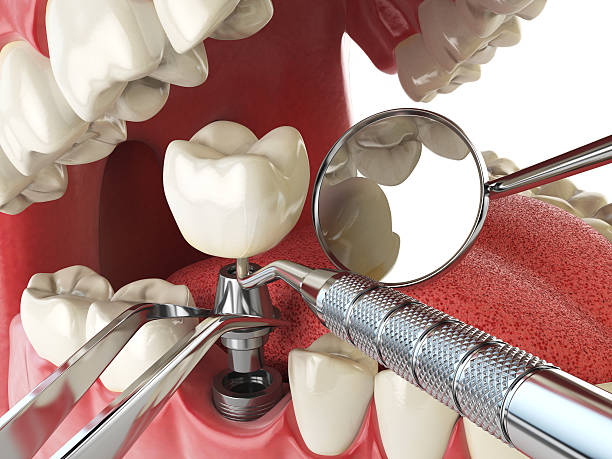 Emergency Dental Filling Replacement in NJ